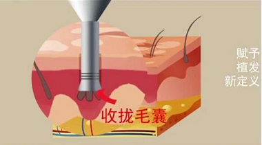 头秃了选择毛发移植怎么样,能打折吗