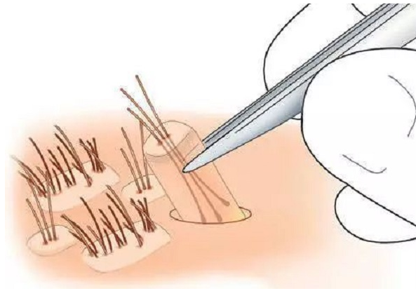 种植毛发要经过那几个步骤