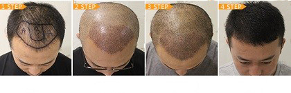 曙光植发种植效果图