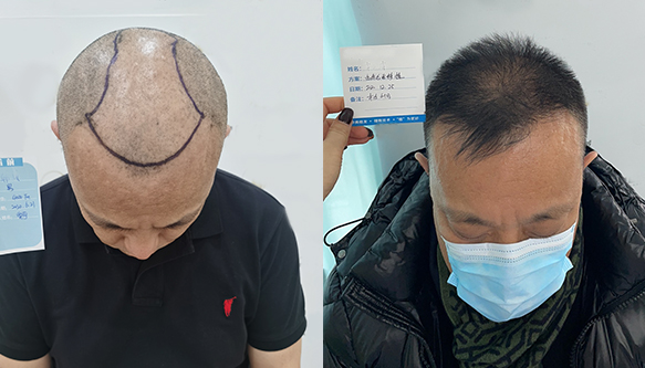 头发种植效果图