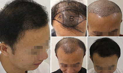 ͷ����ֲЧ��ͼ