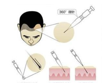 植发是会自己长吗