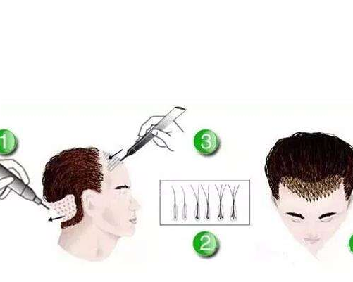 毛发移植的工具都有哪些呢