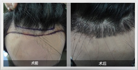 曙光医疗植发效果图