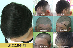 植发效果图