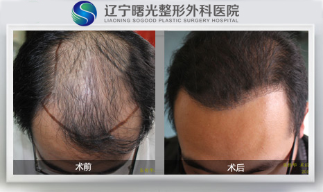 曙光头发种植需要多少钱?