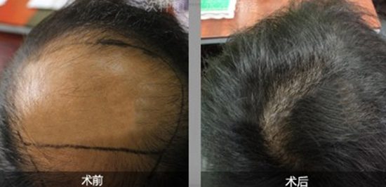 沈阳靠谱的头发种植多少钱?