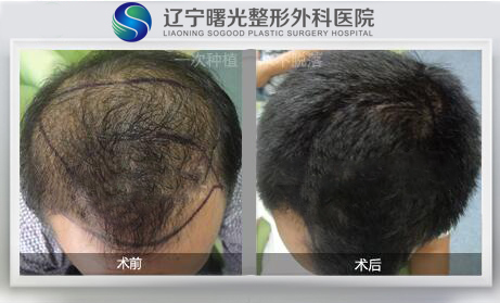 什么因素会影响植发价格?