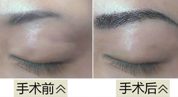 眉毛种植效果图