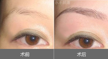 眉毛种植效果图