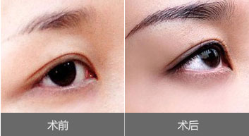 眉毛种植效果图