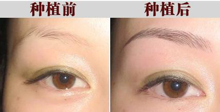 眉毛种植