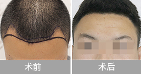 ͷ����ֲЧ��ͼ