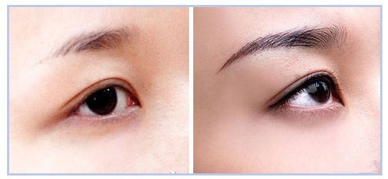 为什么会有人选择眉毛种植?