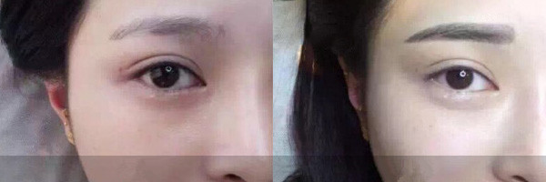 眉毛移植手术之后该怎么护理