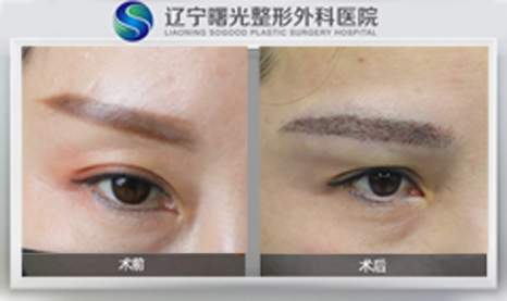 眉毛种植的原理和效果是怎样的
