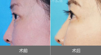 睫毛种植有副作用吗?