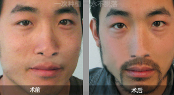 胡须种植是怎么收费的呢