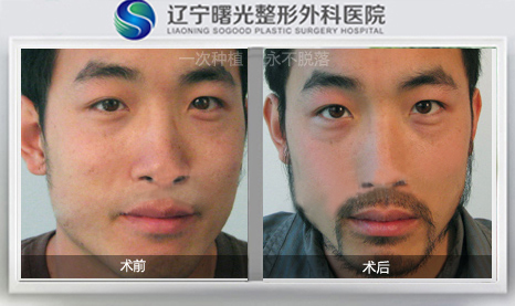 专家带您了解胡须种植的特点