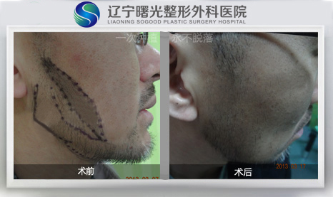 胡须不够密怎么办