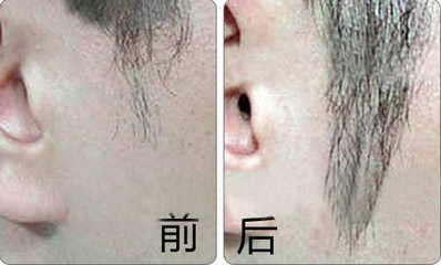 鬓角种植费用是否“天价”?