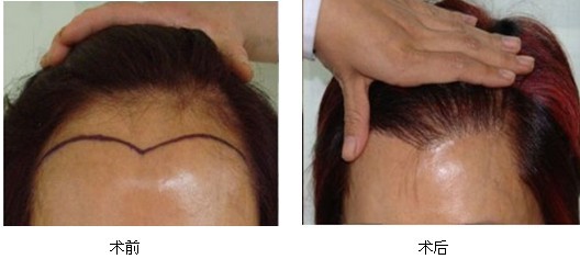 美人尖种植哪家医院好