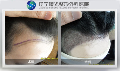 美人尖植发多少钱