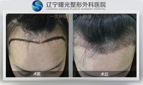 美人尖种植效果是长久性的吗?