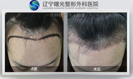 美人尖种植的优势在哪里?