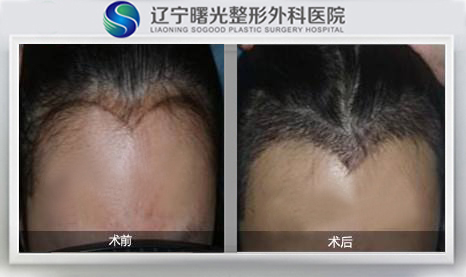 美人尖种植效果图