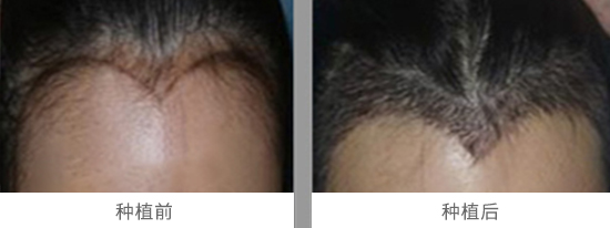 美人尖种植效果图