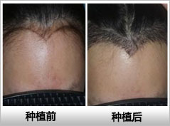 �����ļ�ҽԺ��ֲ<a href=http://www.chinamaofa.com/meirenjianzz/ target=_blank class=infotextkey>���˼�</a>��Ч����