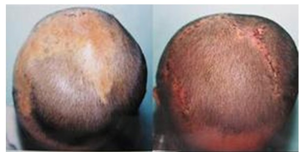 老年人也能植发吗?