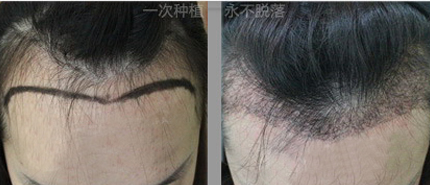 沈阳美人尖种植价格是多少钱呢