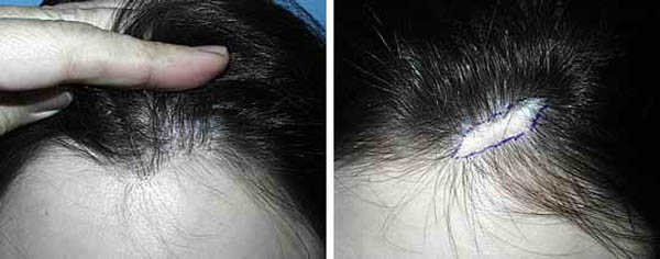 头部疤痕不长发怎么办