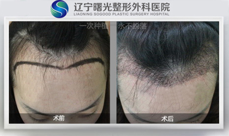 发际线种植去哪里好啊?