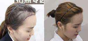 毛发移植的技术效果好不好