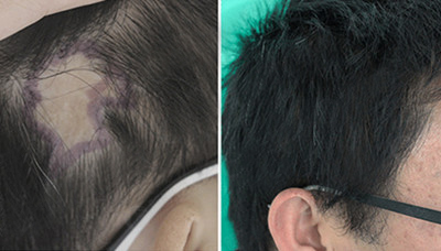 疤痕毛发移植的技术效果好不好