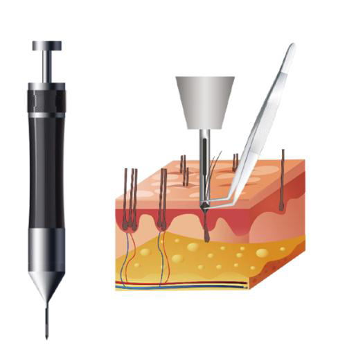 微针植发技术