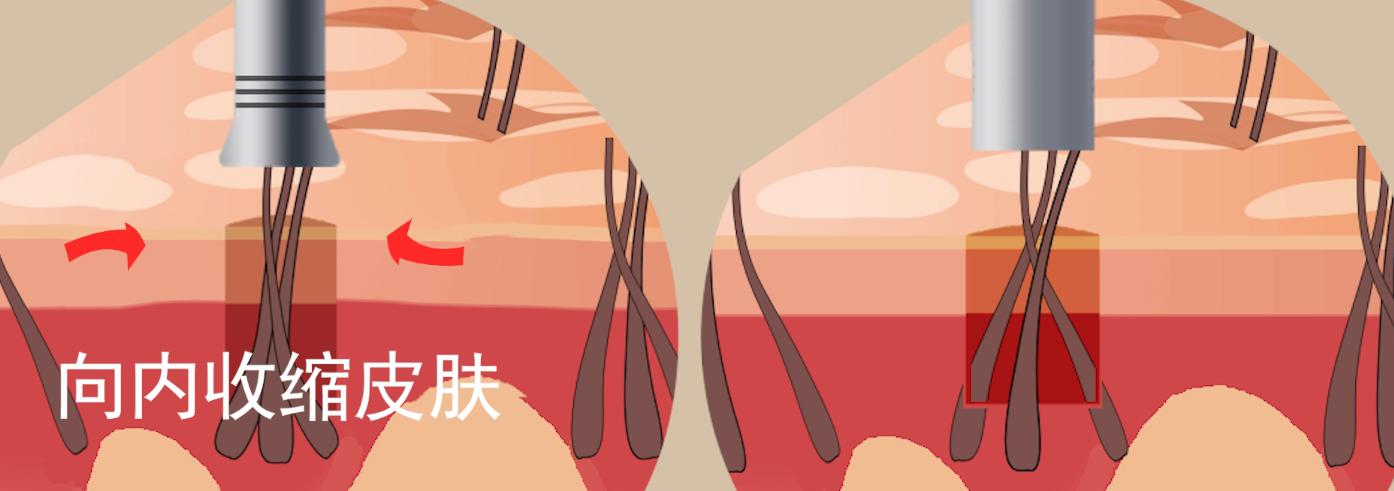 微针植发技术治疗脂溢性脱发怎么样