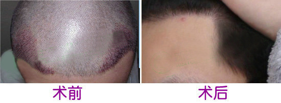 曙光植发微针植发治疗脱发的效果好