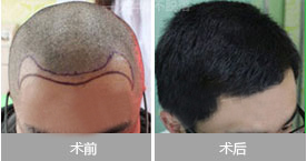 头发种植效果图
