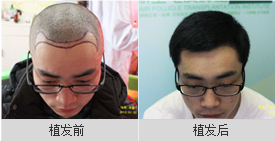 脱发有治疗对侧吗