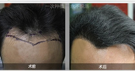 头发种植效果图