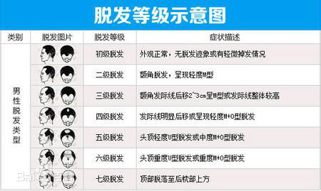 脱发分级图