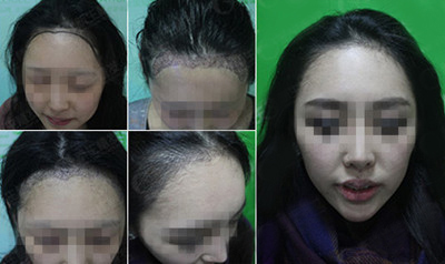 女性掉头发的原因都有哪些