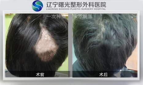 出现鬼剃头该如何治疗