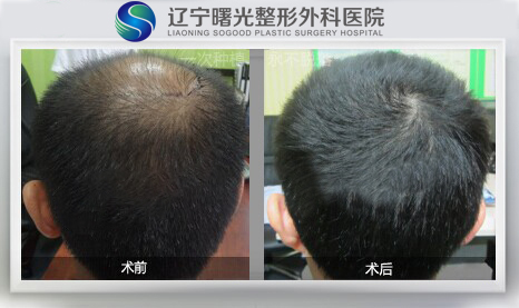 脱发的症状表现有哪些